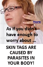 If a person has skin tags on their skin, this means that colonies of deadly parasites have settled in their internal organs and are slowly eating your flesh. According to statistics, more than one billion people are infected with parasites. Well, that's a comforting thought.